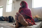 Sukuelinten silpomisen kokenut tyttö Etiopiassa.